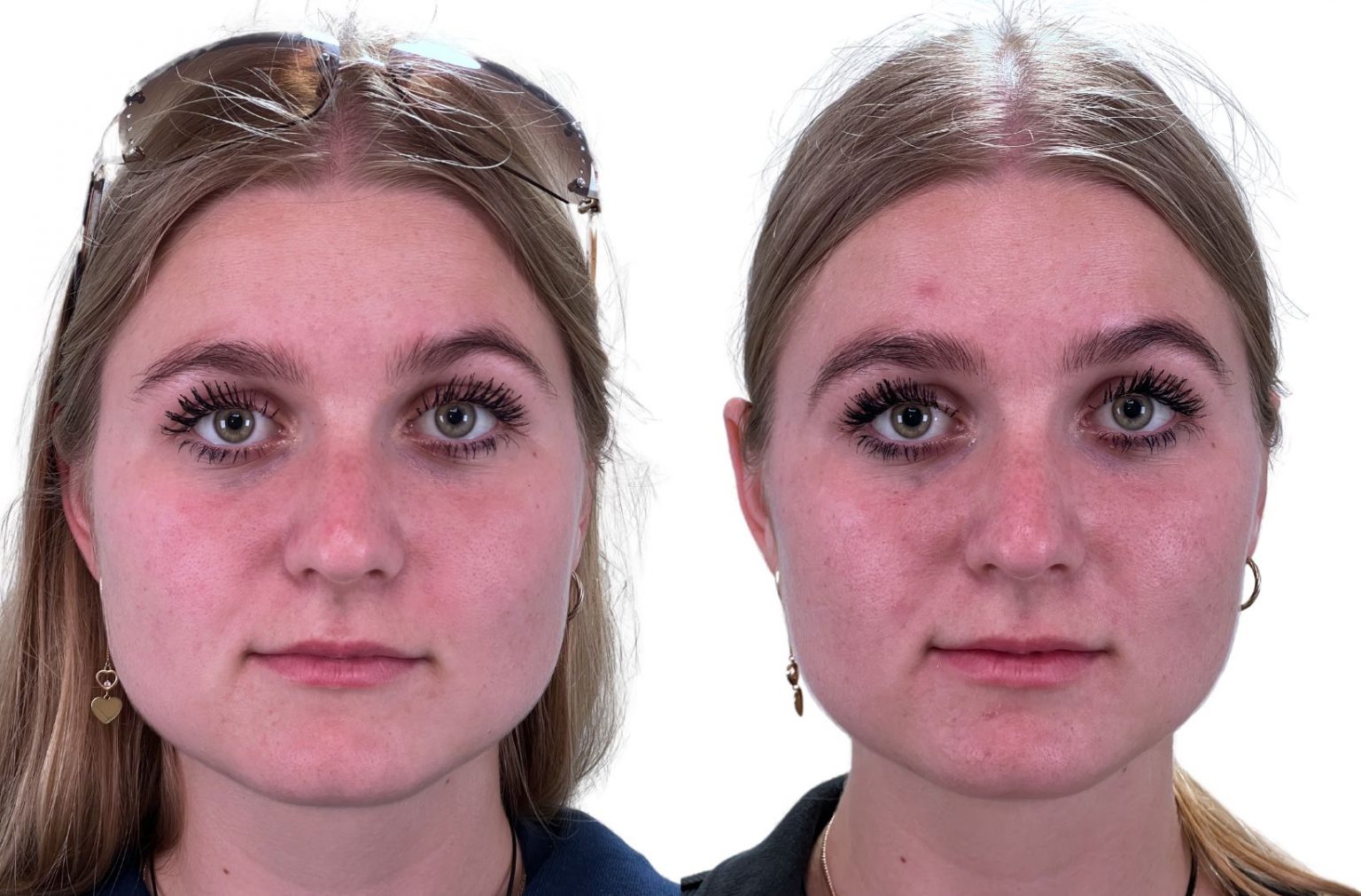 Botox