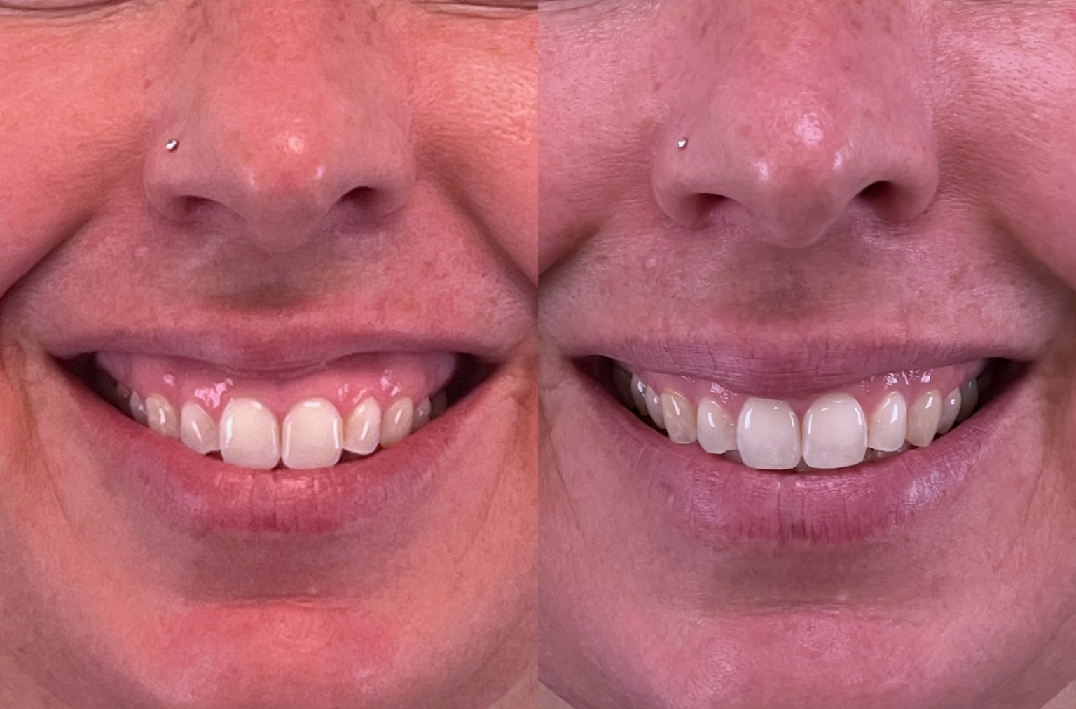 Botox