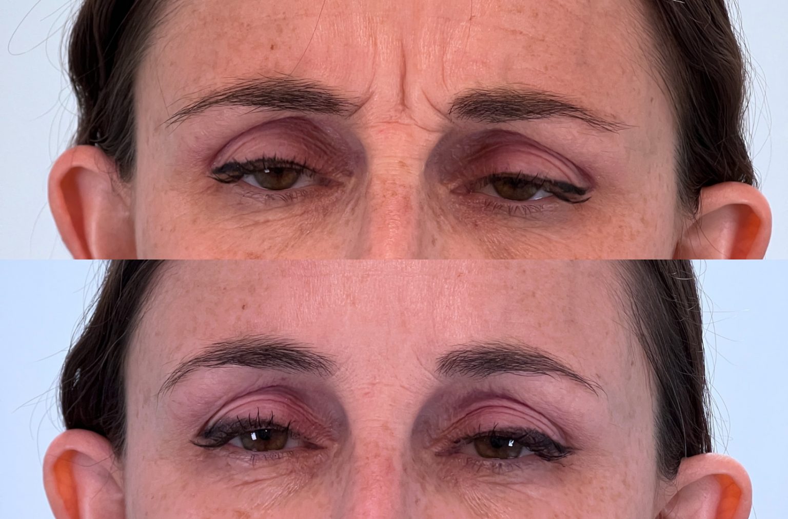 Botox