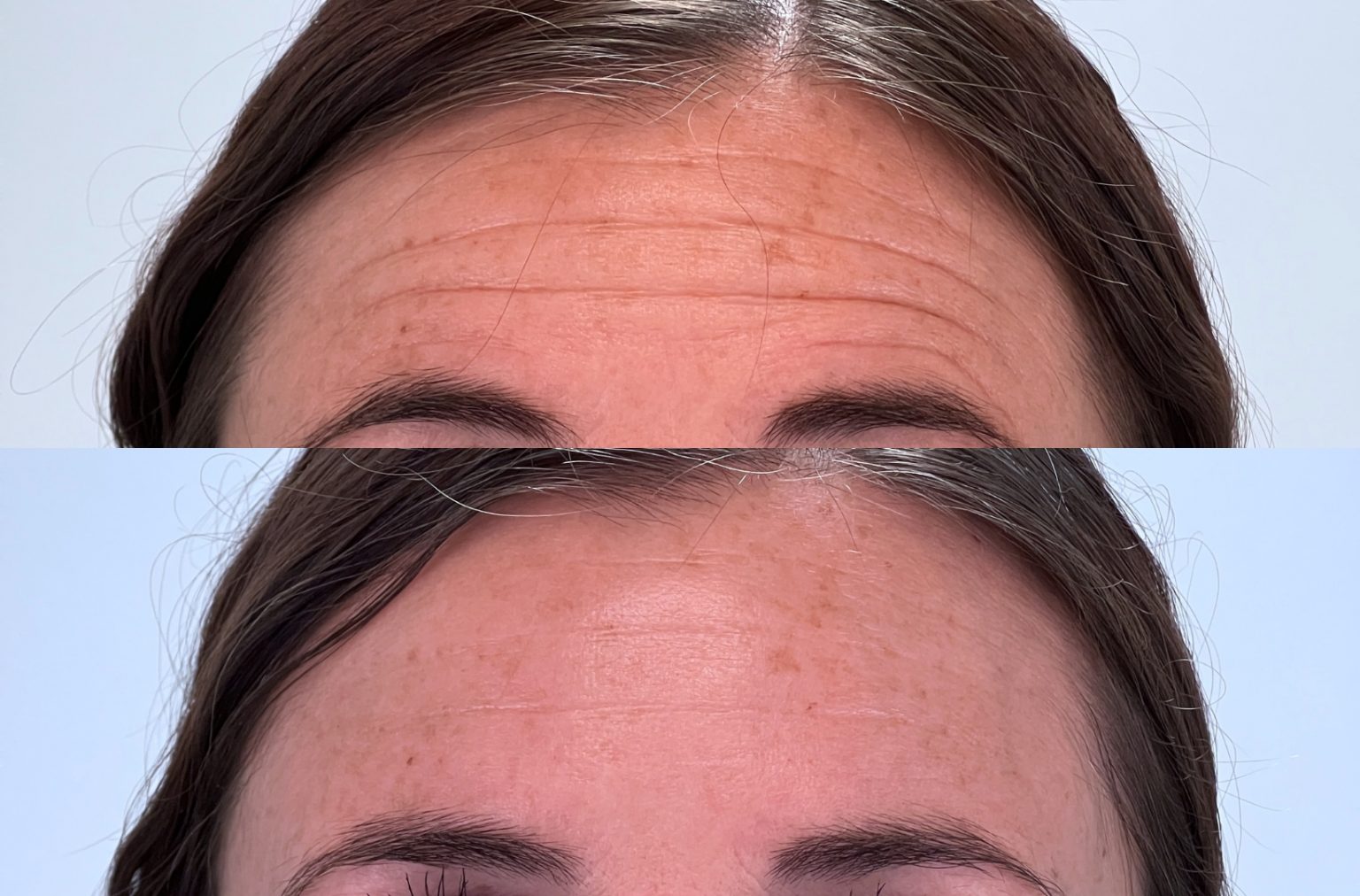 Botox