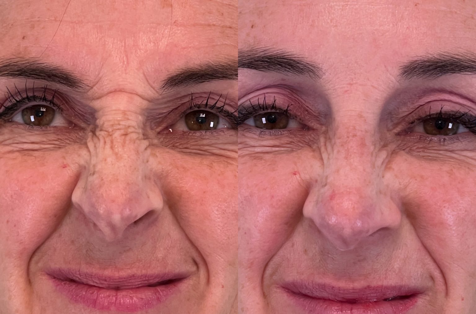 Botox