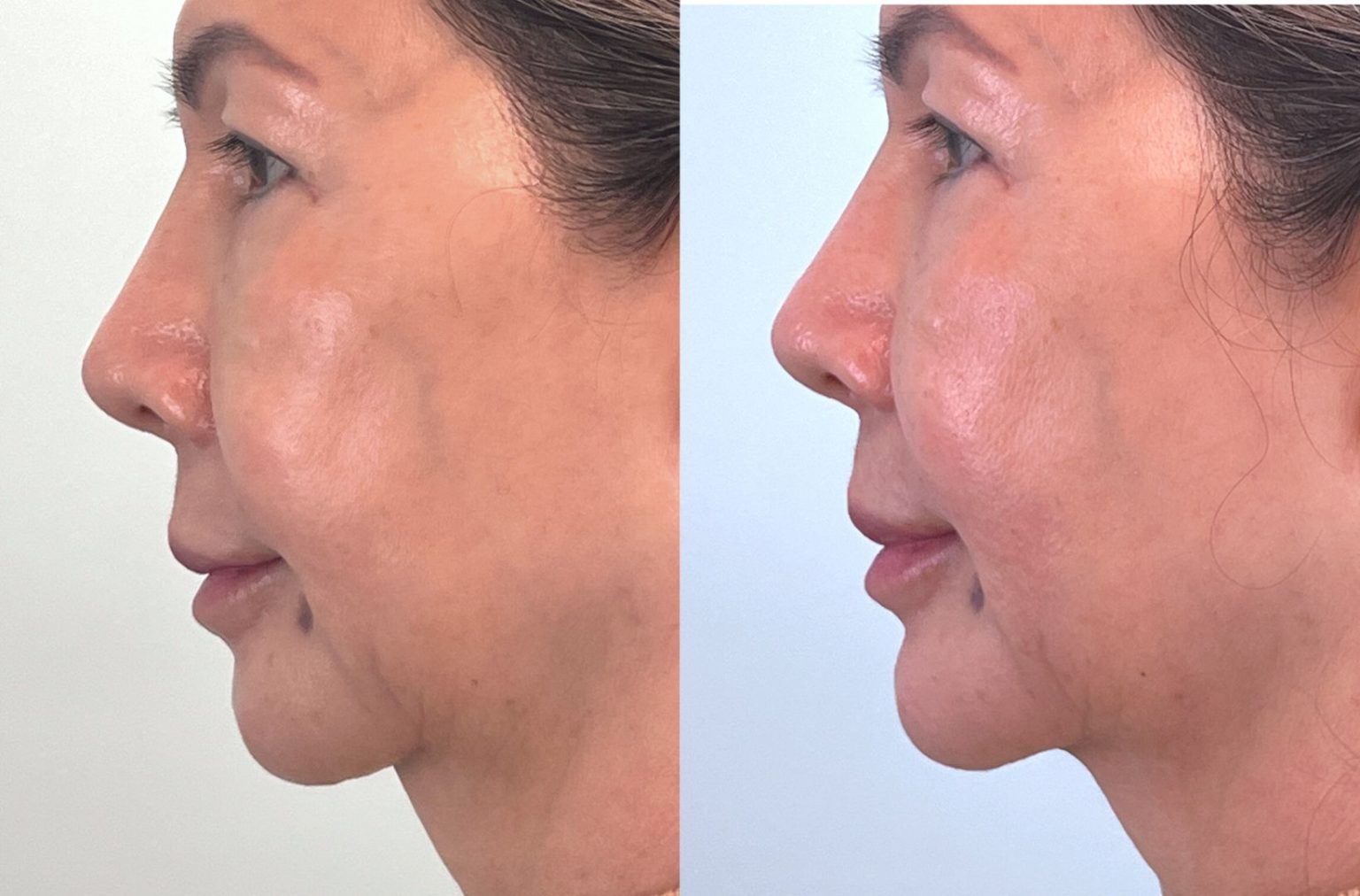 Chin Augmentation