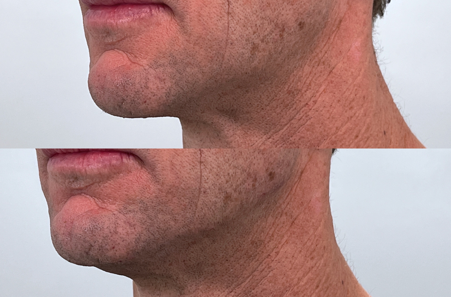 Jaw & Chin Augmentation