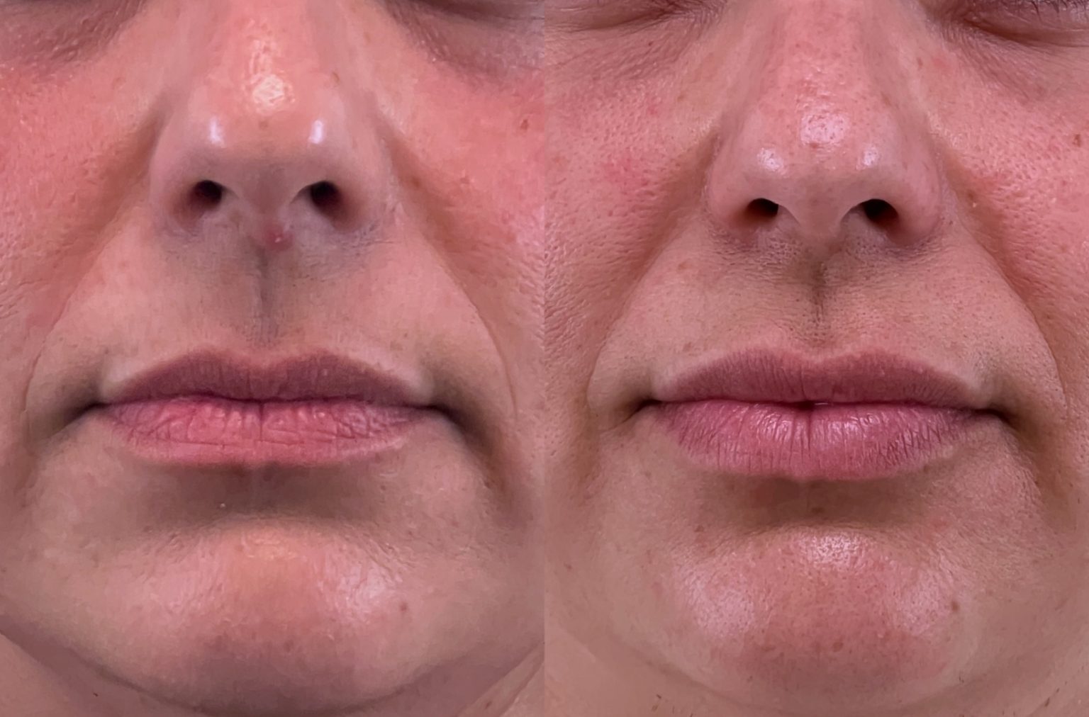Lip Augmentation