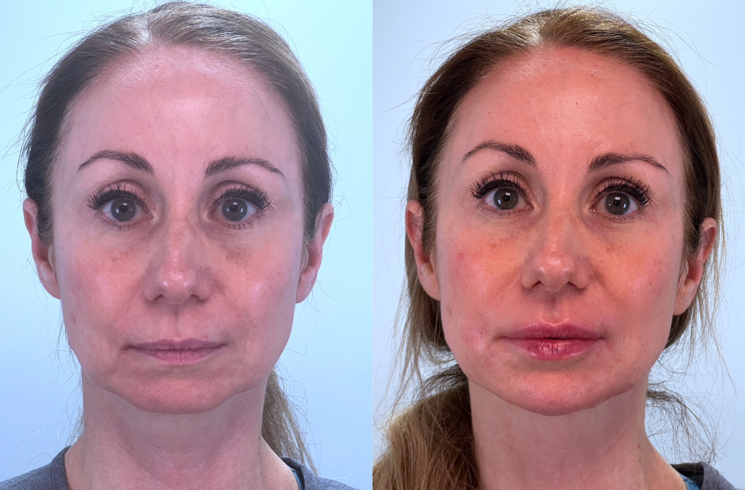 Facial Rejuvenation