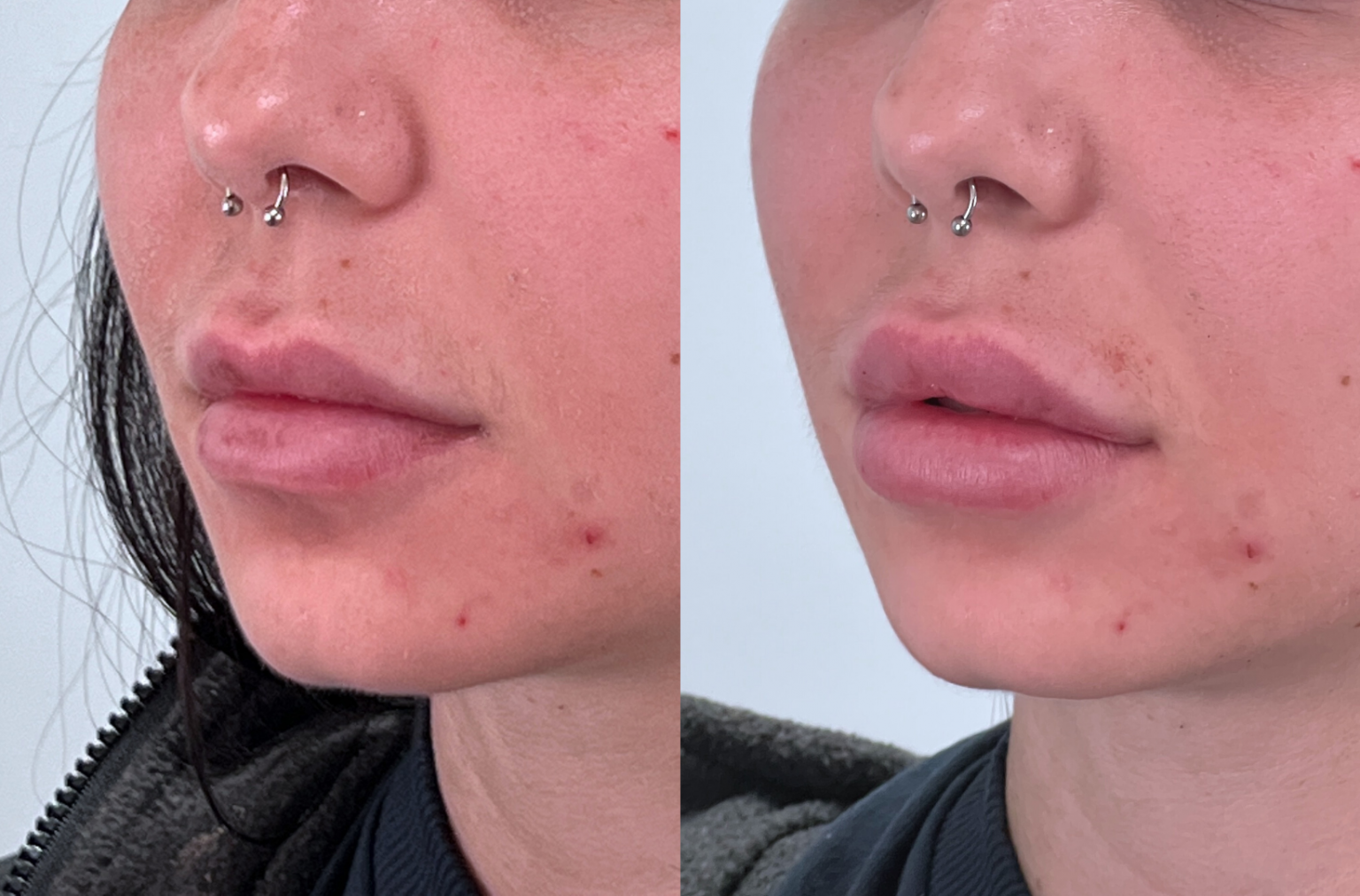 Lip Augmentation