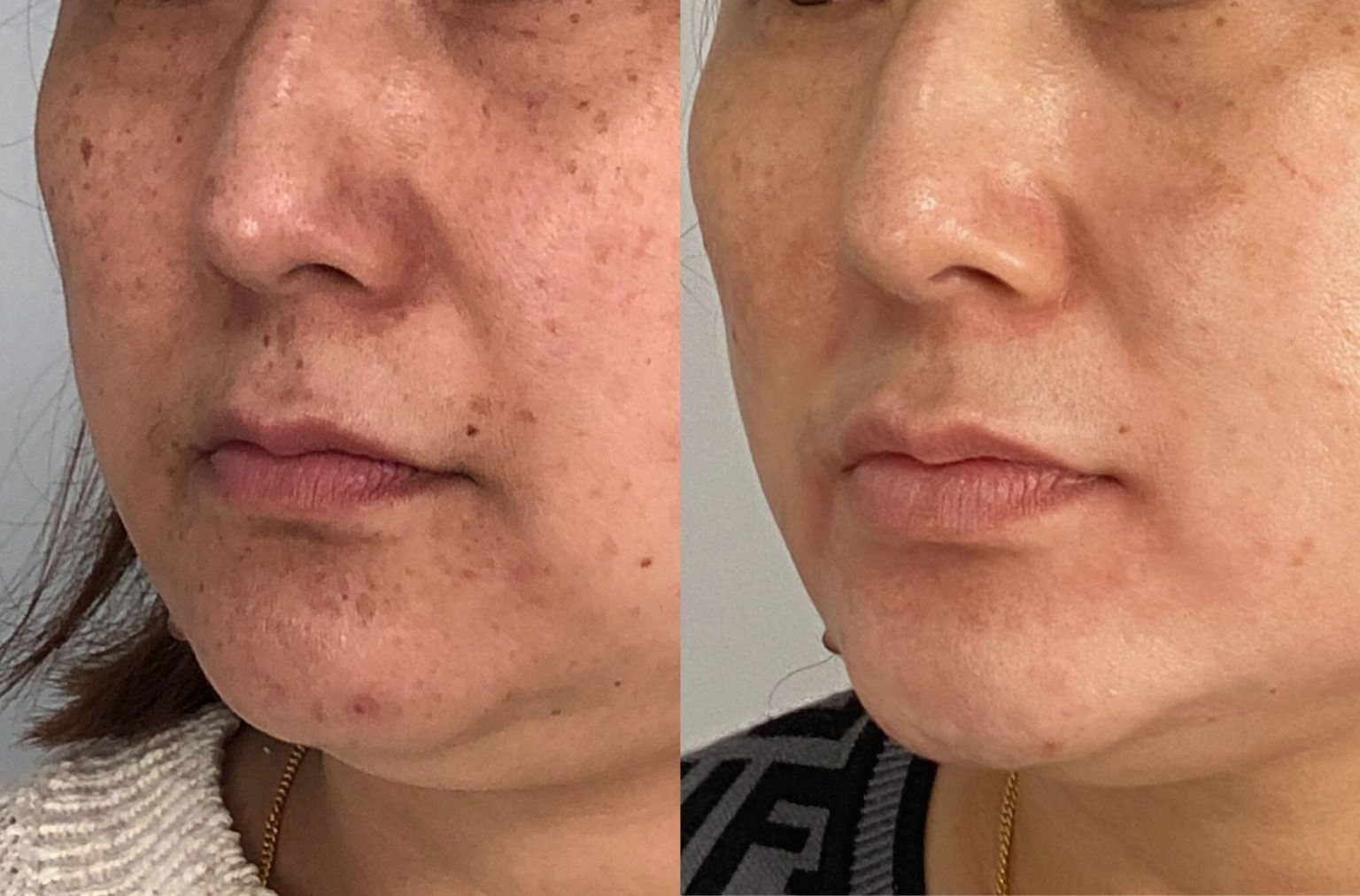 VI Peel Precision Plus