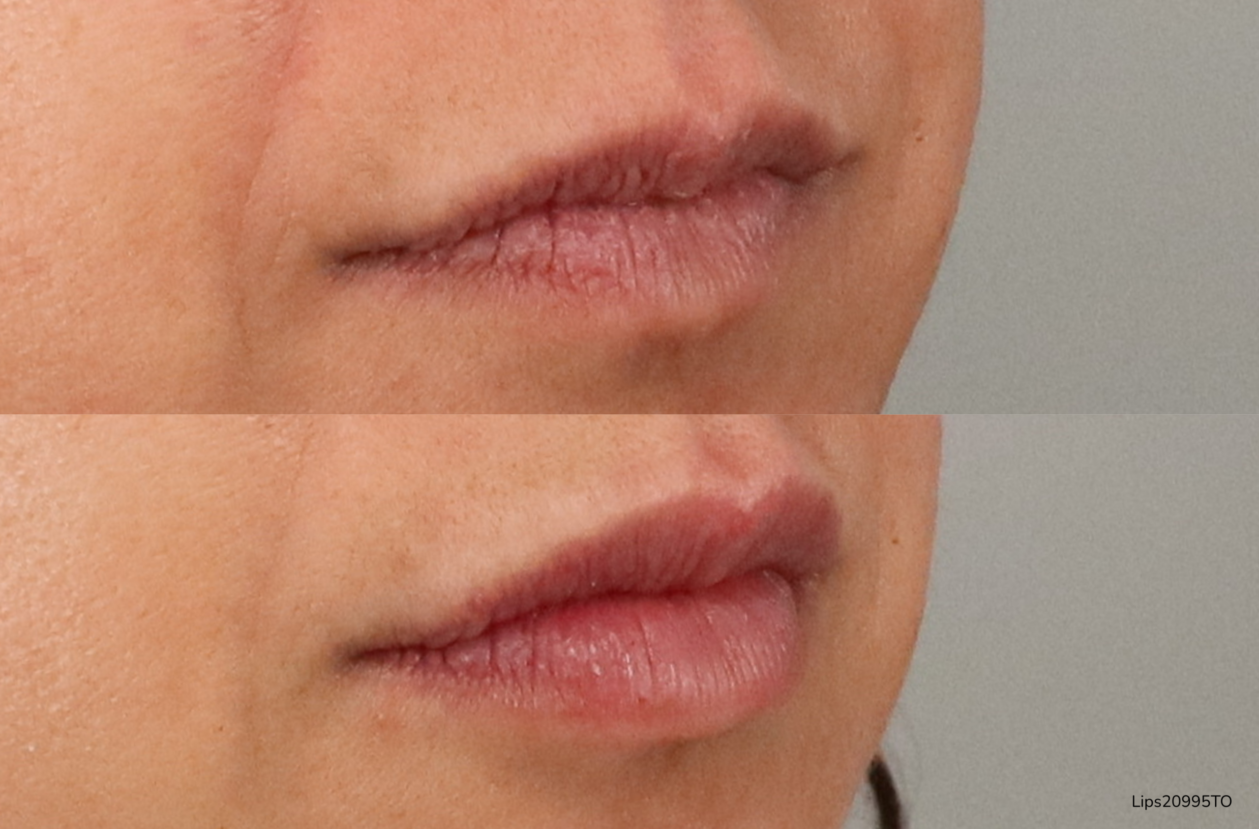 Before (top) After (bottom) of lip augmentation.