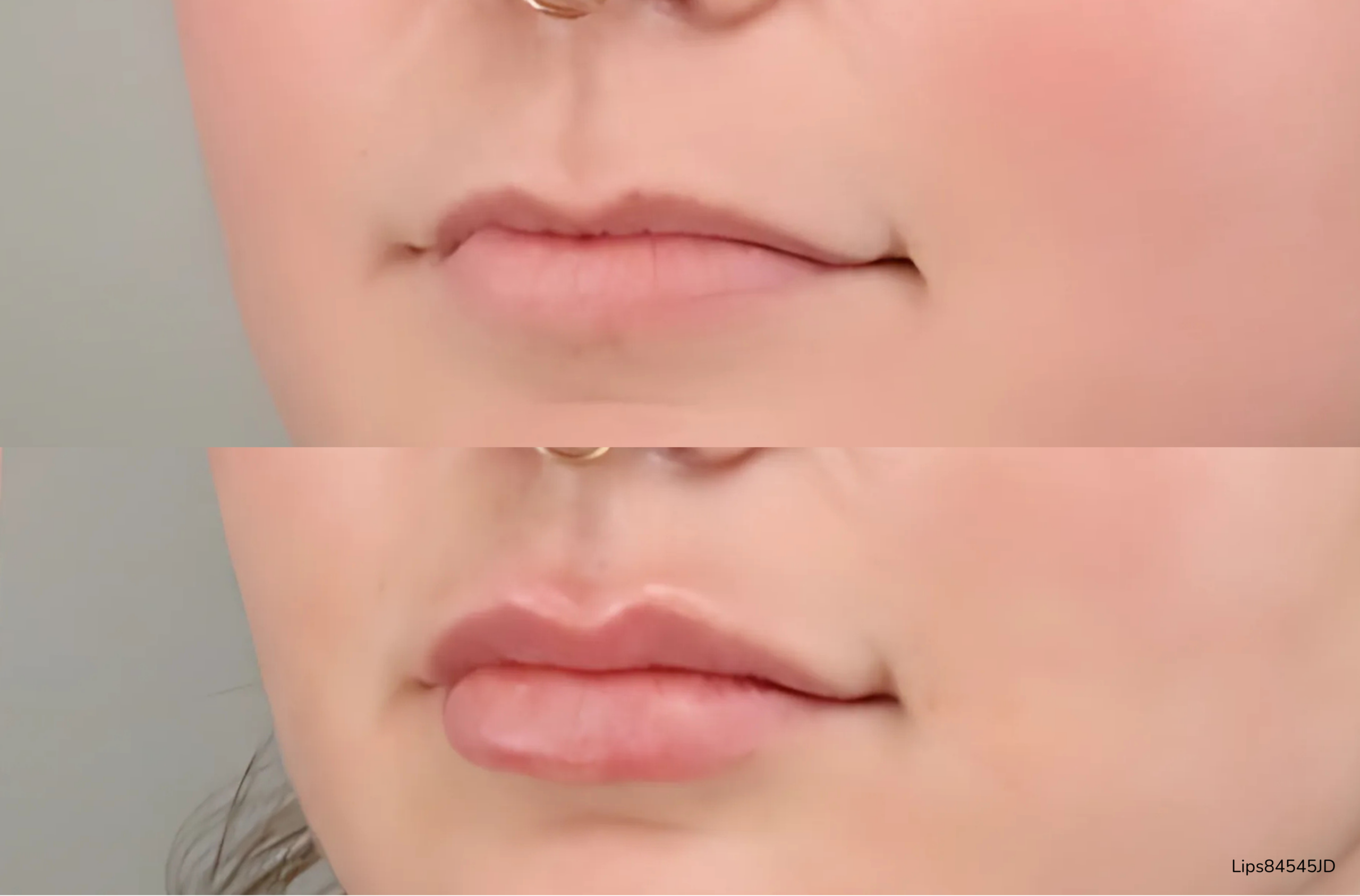 Picture of Before and After of lips of a woman. The top photo shows the before photo of the lips and the bottom photo shows the after photo of the lips plumped after dermal filler treatment.Picture of Before and After of lips of a woman. The top photo shows the before photo of the lips and the bottom photo shows the after photo of the lips plumped after dermal filler treatment.