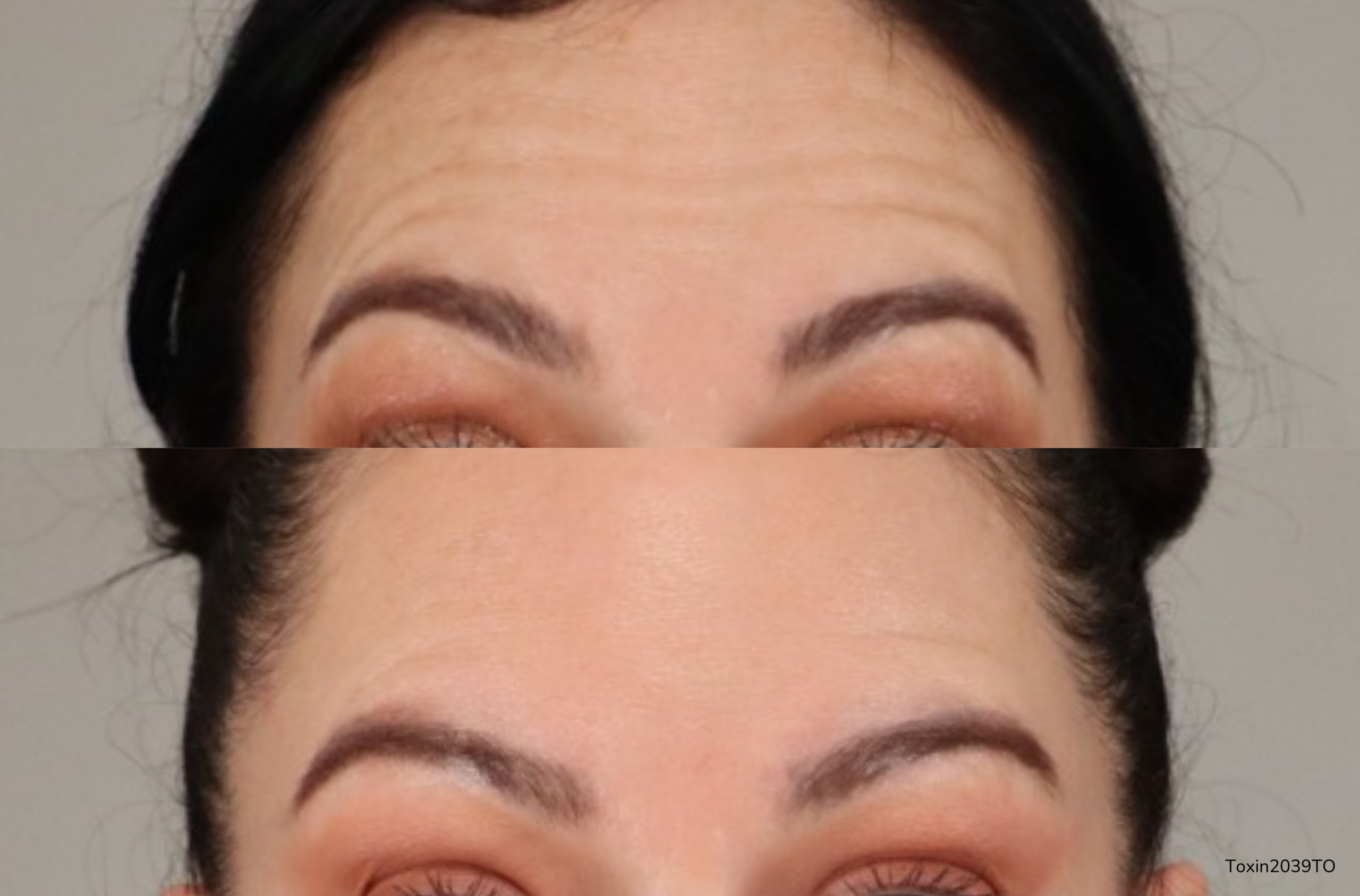 Before and After photo of a woman's forehead. On top raising brows which is creating horizontal wrinkles across the forehead. The bottom half of the picture shows a smooth forehead.