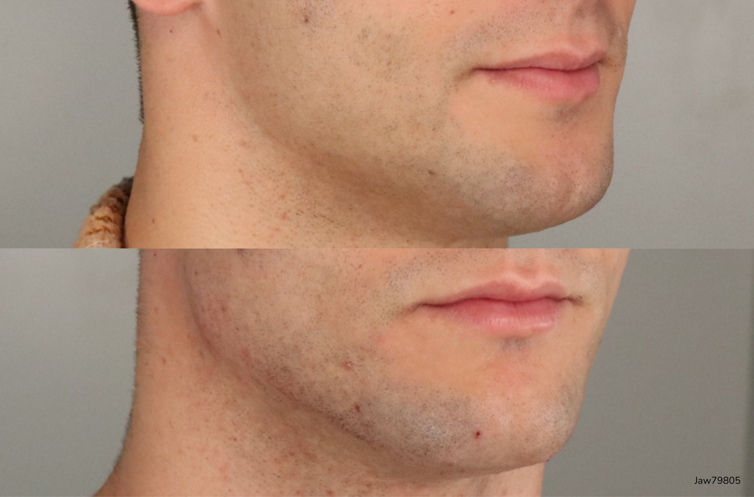 Before (top) After (bottom) of jaw and chin augmentation after dermal fillers